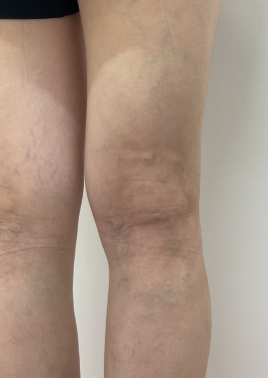下肢静脈瘤の症例