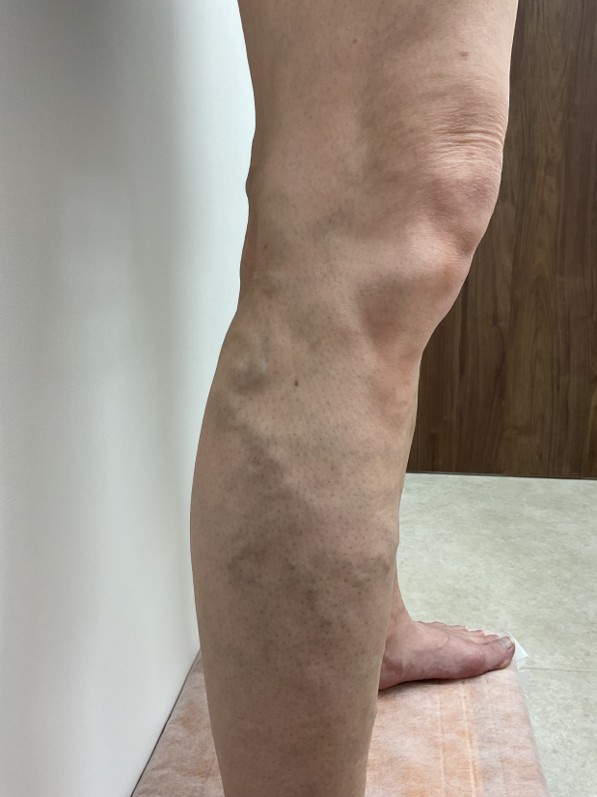 下肢静脈瘤の症例