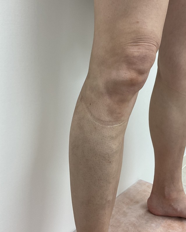 下肢静脈瘤の症例