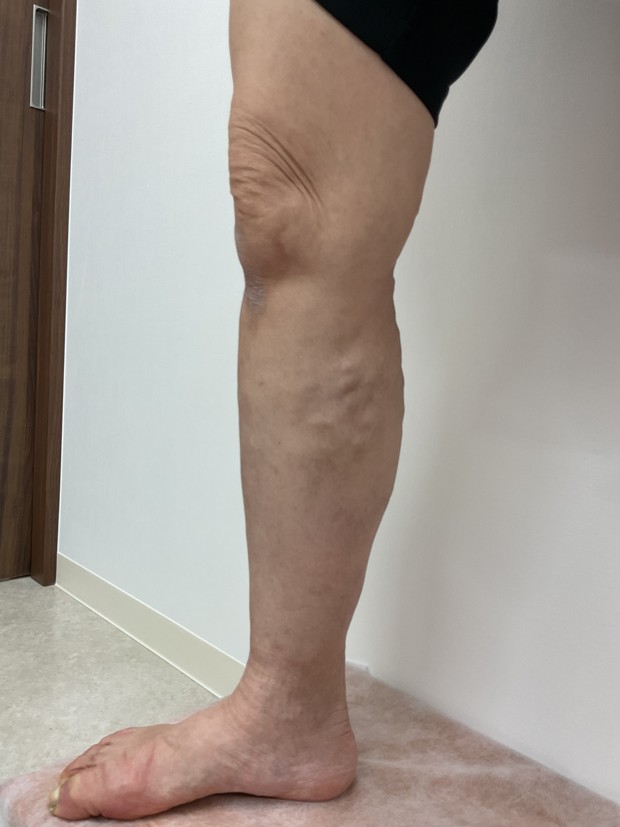 下肢静脈瘤の症例