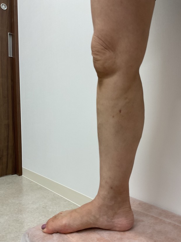 下肢静脈瘤の症例