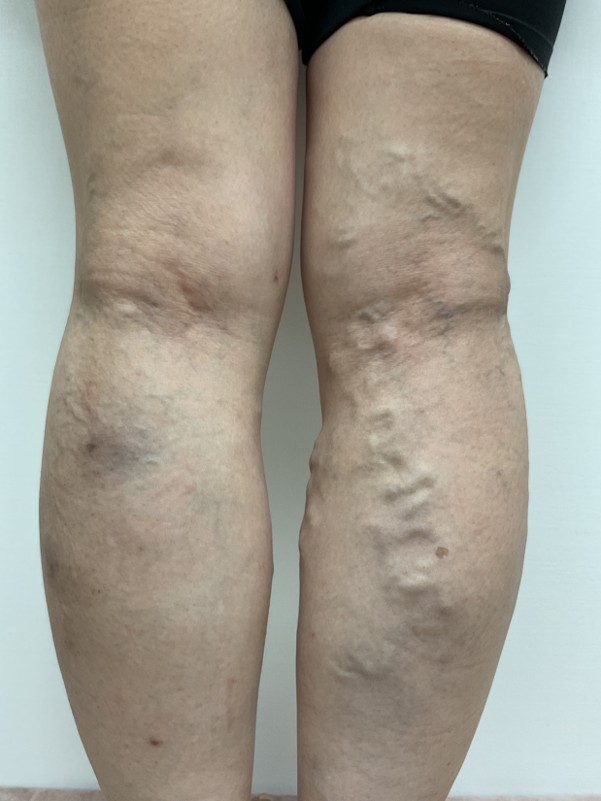 下肢静脈瘤の症例