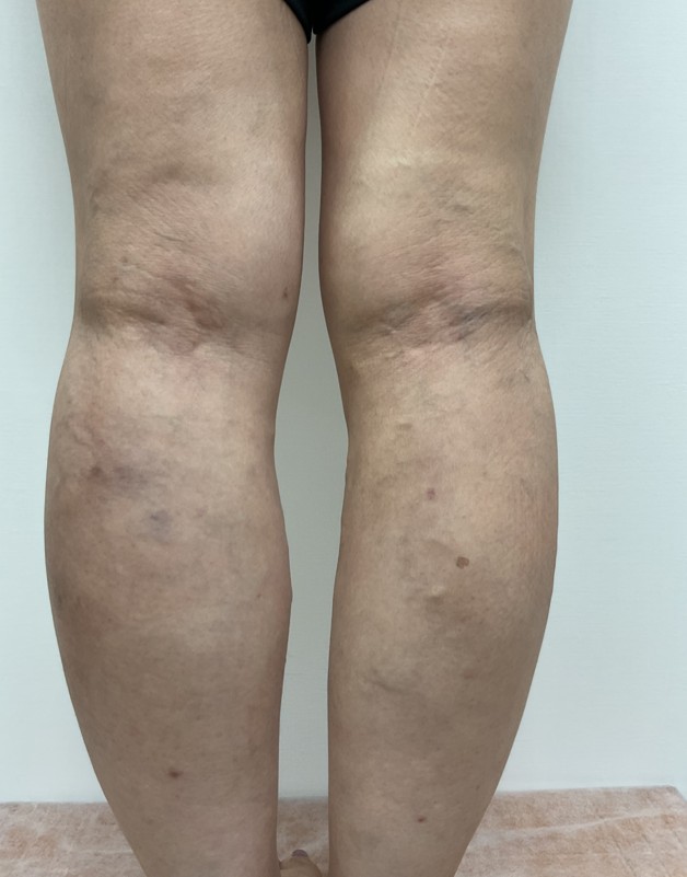下肢静脈瘤の症例