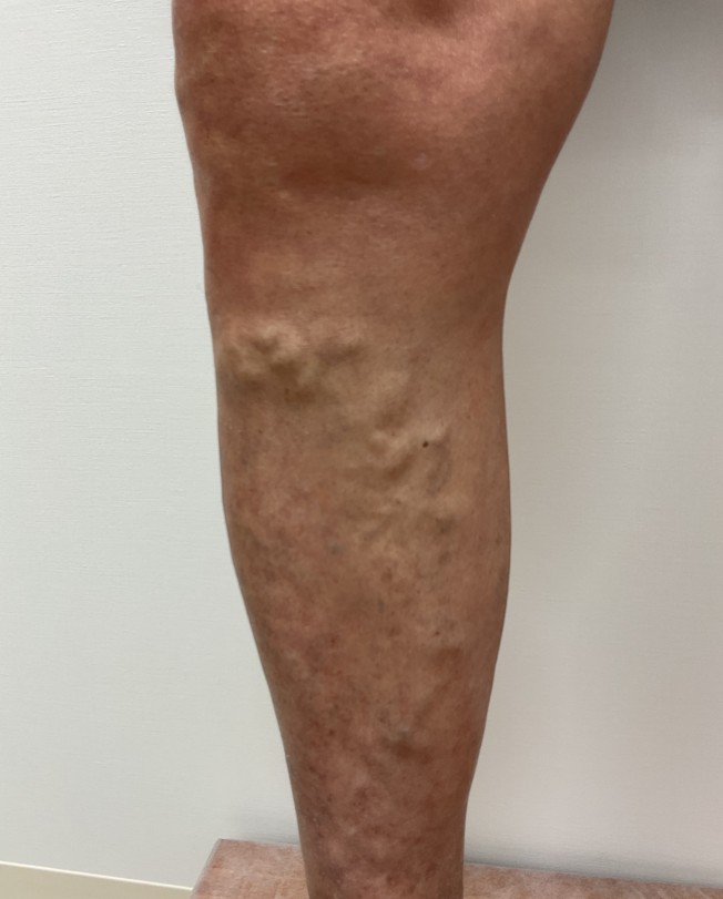 下肢静脈瘤の症例