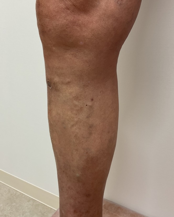 下肢静脈瘤の症例