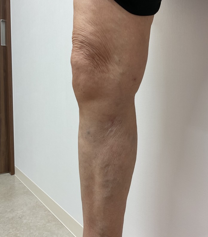 下肢静脈瘤の症例