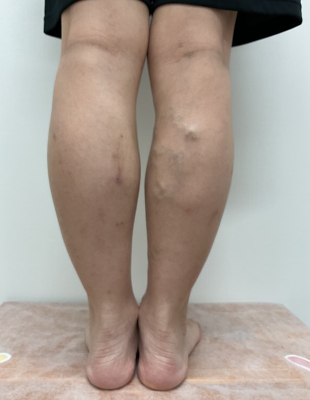下肢静脈瘤の症例
