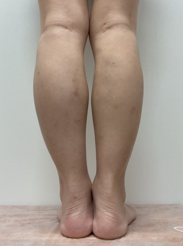 下肢静脈瘤の症例