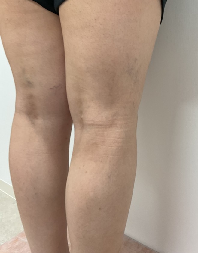 下肢静脈瘤の症例