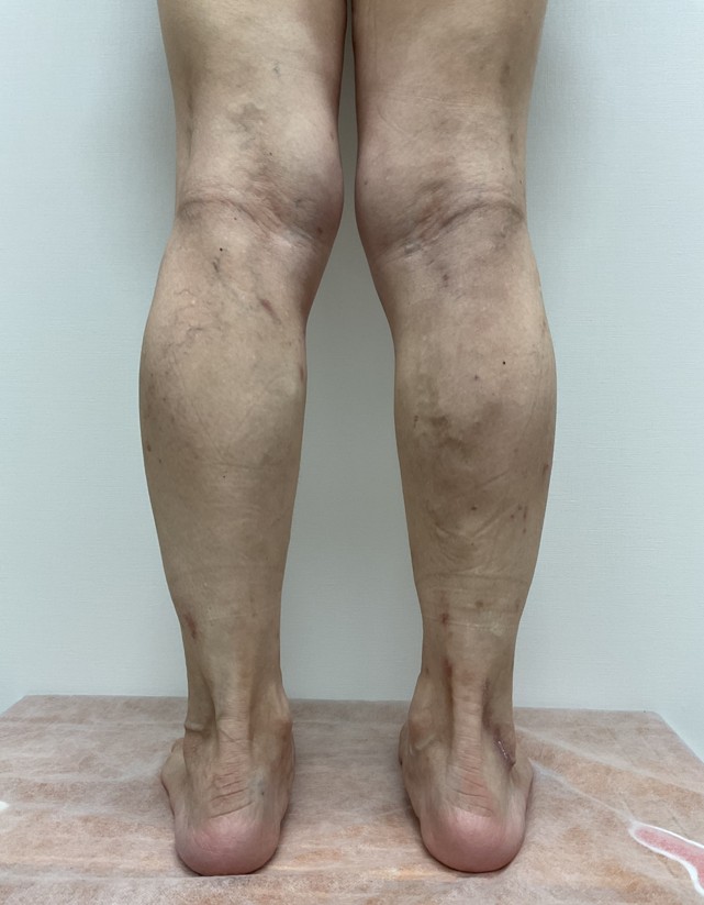 下肢静脈瘤の症例