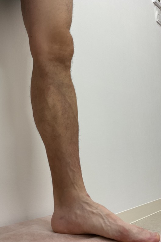 下肢静脈瘤の症例