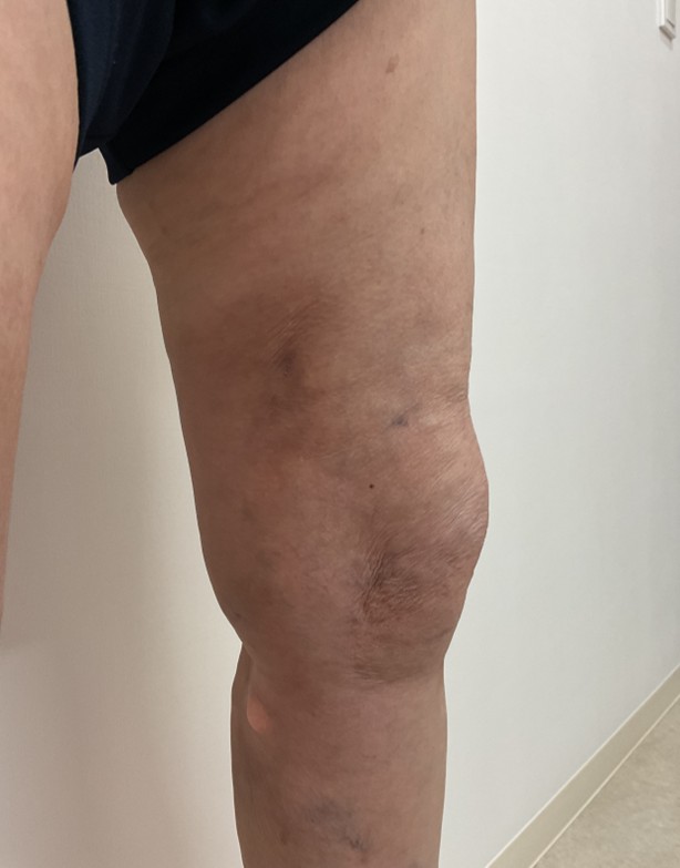 下肢静脈瘤の症例