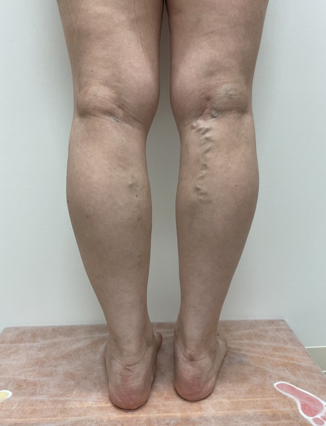 下肢静脈瘤の症例