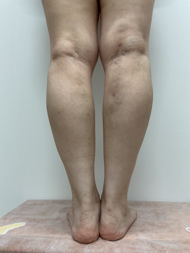 下肢静脈瘤の症例