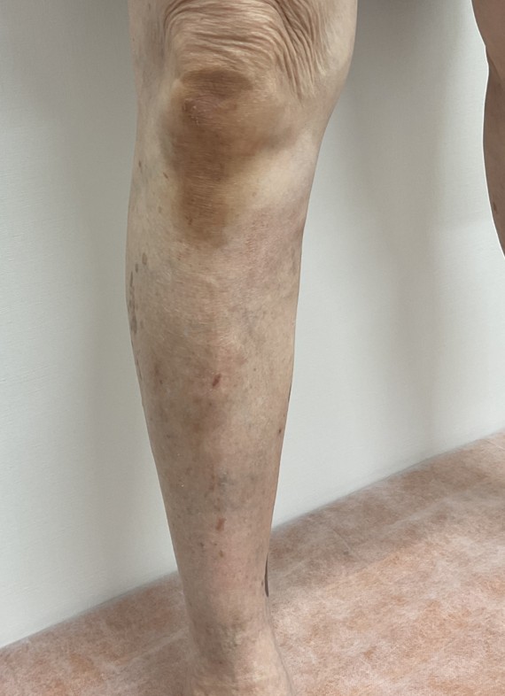 下肢静脈瘤の症例