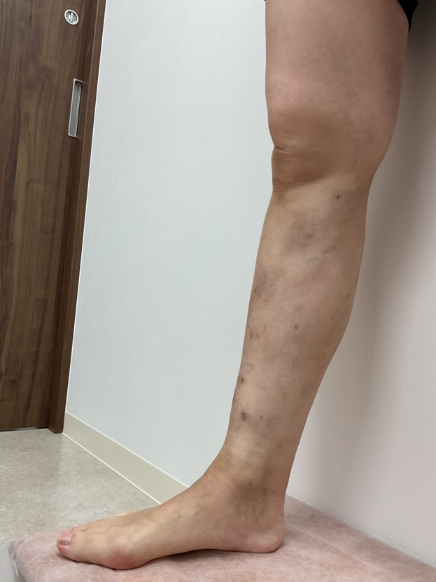 下肢静脈瘤の症例