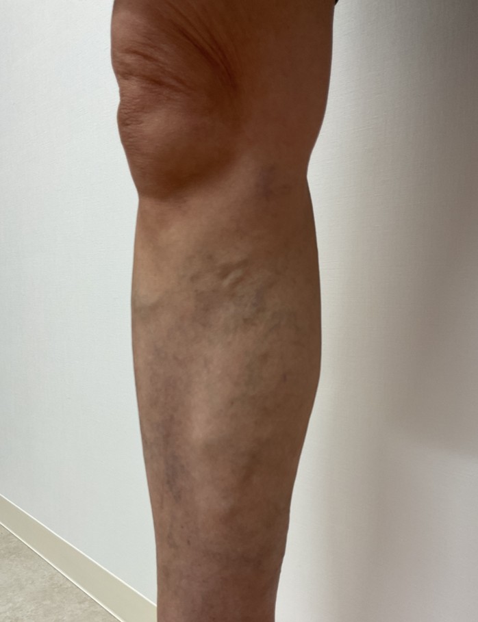 下肢静脈瘤の症例