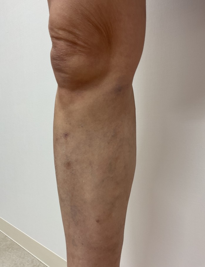 下肢静脈瘤の症例