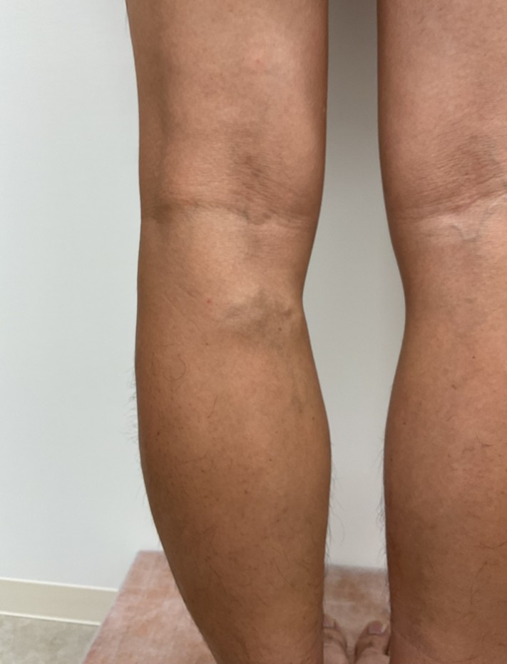 下肢静脈瘤の症例