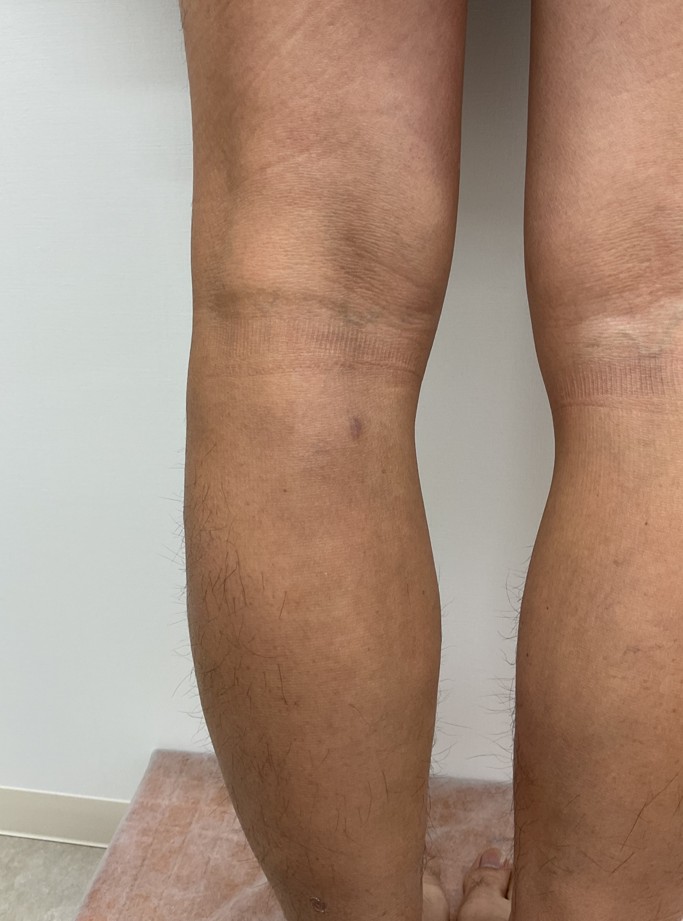 下肢静脈瘤の症例