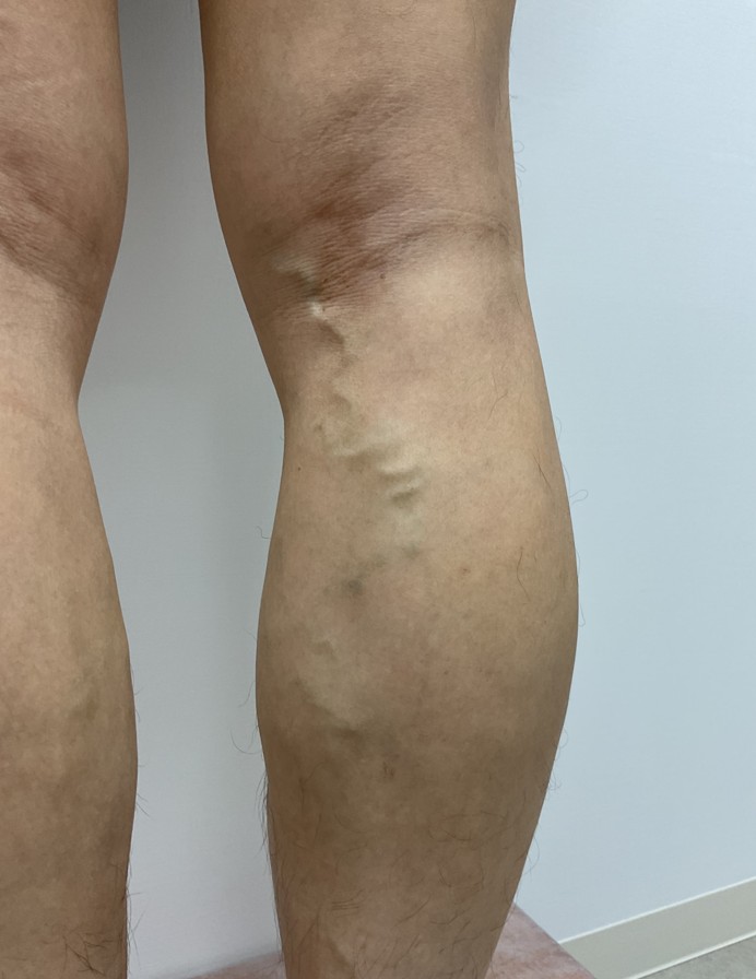 下肢静脈瘤の症例