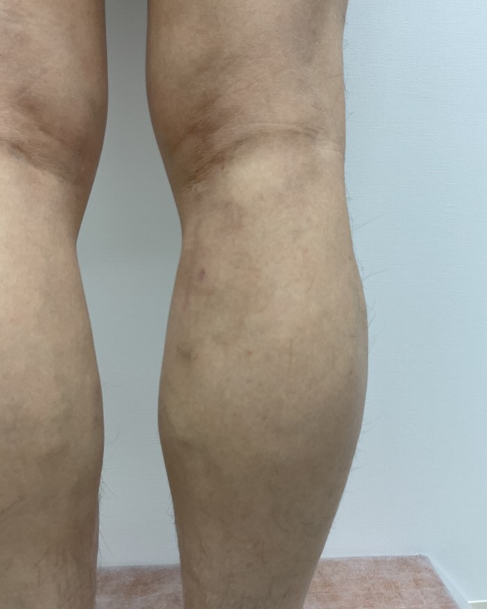 下肢静脈瘤の症例